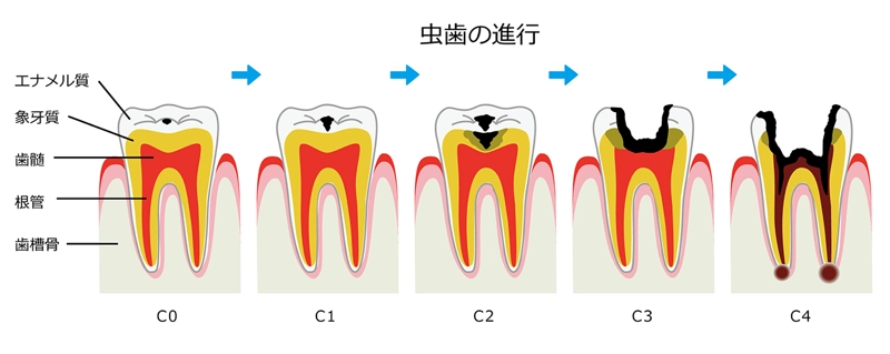 虫歯の症状と特徴(進行)