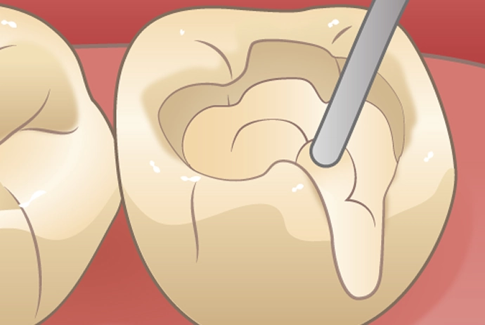 コンポジットレジン充填（ダイレクトボンディング）