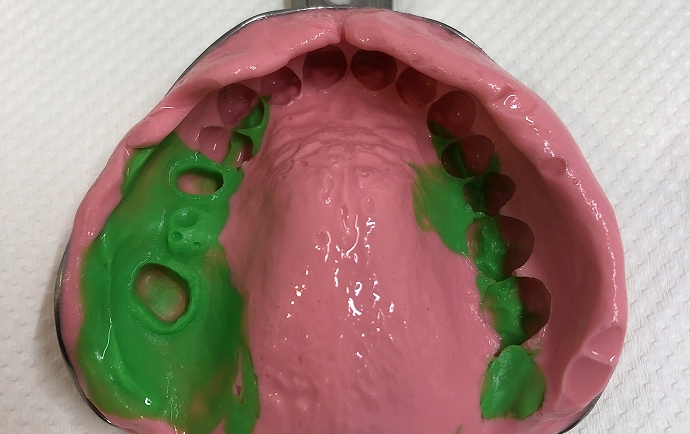 シリコン印象材による歯型の採取