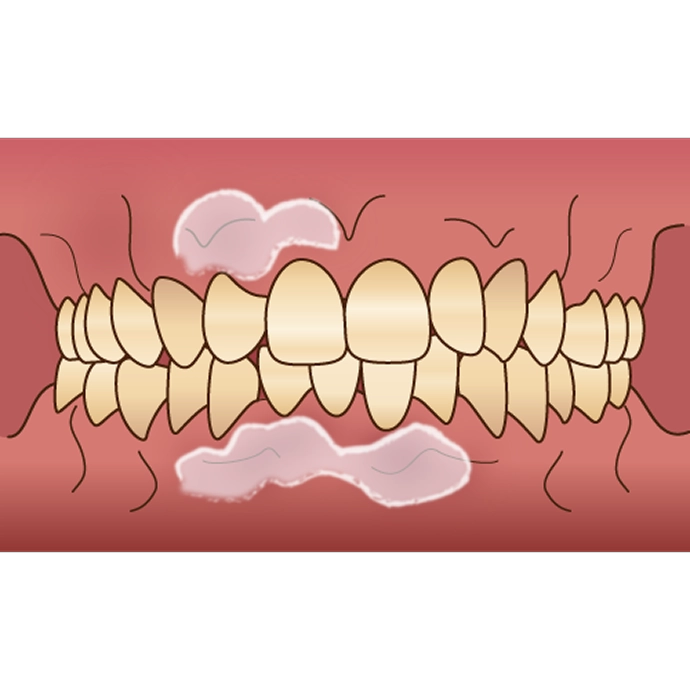 ガムピーリング