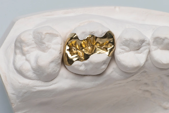 ゴールドインレー