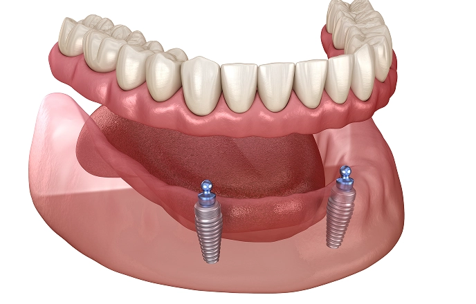 3Dコンピューターインプラントシステム