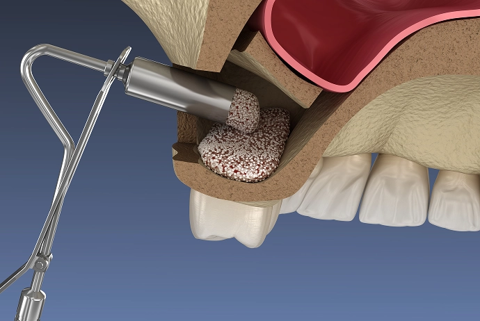 骨再生療法（サイナスリフト、ソケットリフト、GBR）