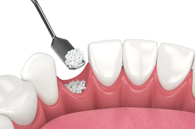 リッジプリザベーション