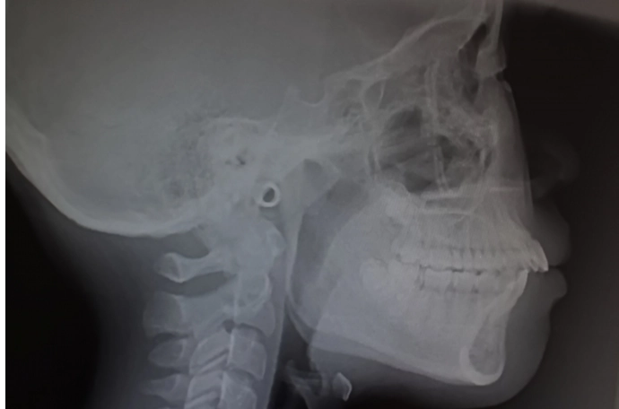 マウスピース矯正