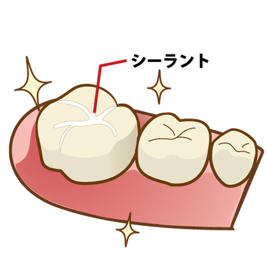 シーラント填塞（奥歯の溝を埋めて虫歯予防）