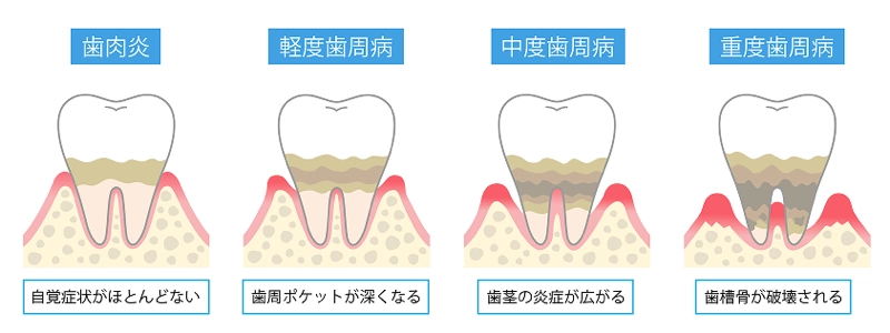 歯周病の進行について