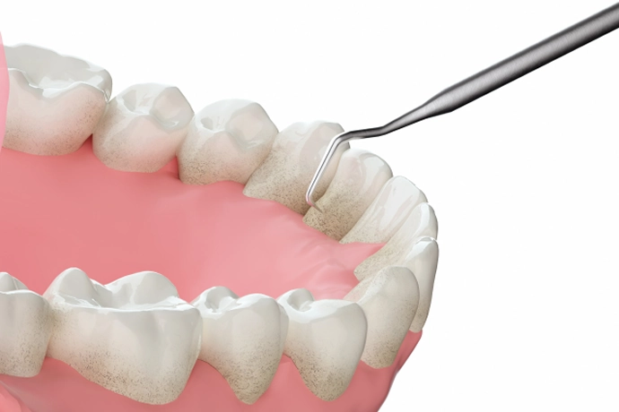 歯周ポケット検査