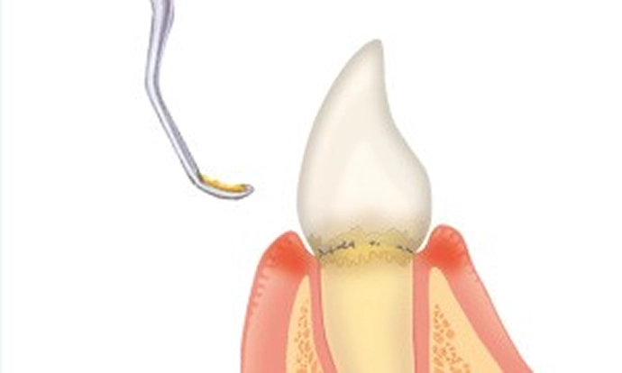 エムドゲイン法