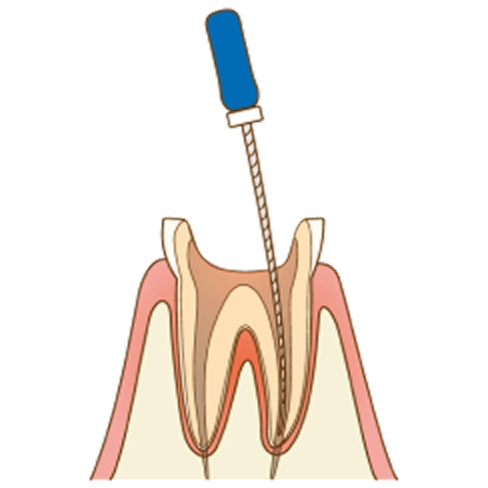 再根管治療