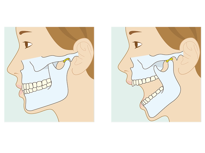 K-7による咬合診断