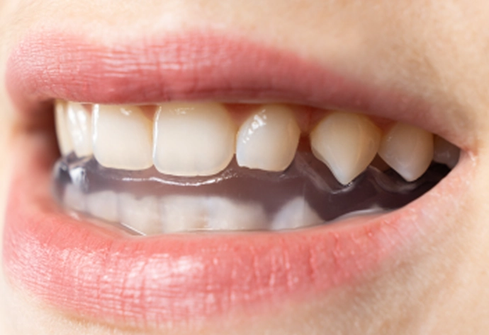 スプリント療法（ナイトガード）