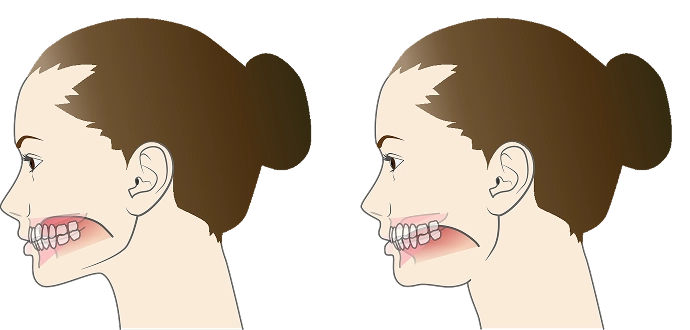 TCH（歯列接触癖）への行動修正