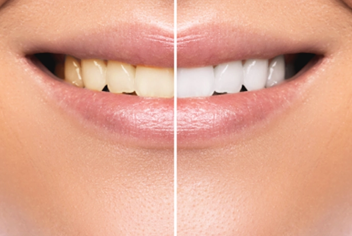 ホワイトニング