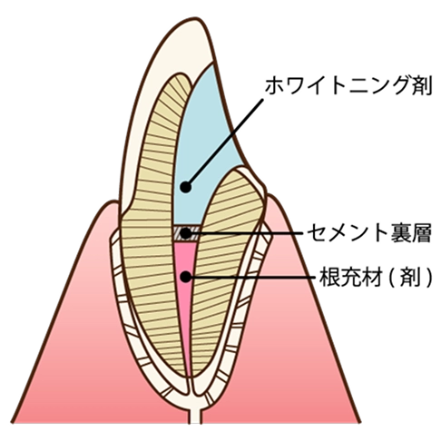 デュアルホワイトニング