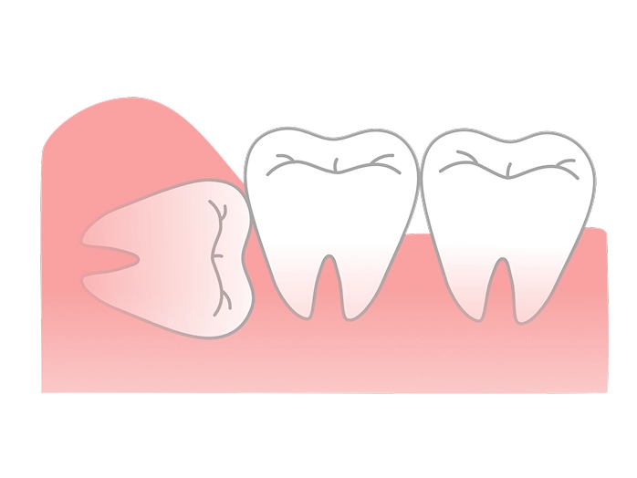 水平埋伏歯の外科的抜歯