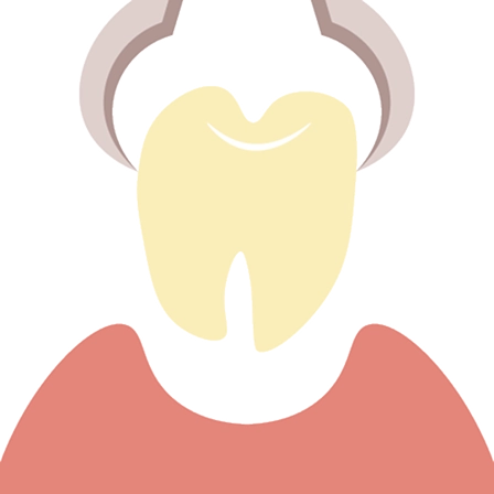 複数本同時抜歯