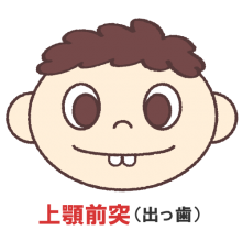 上顎前突（出っ歯）
