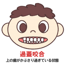 過蓋咬合（深い噛み合わせ）