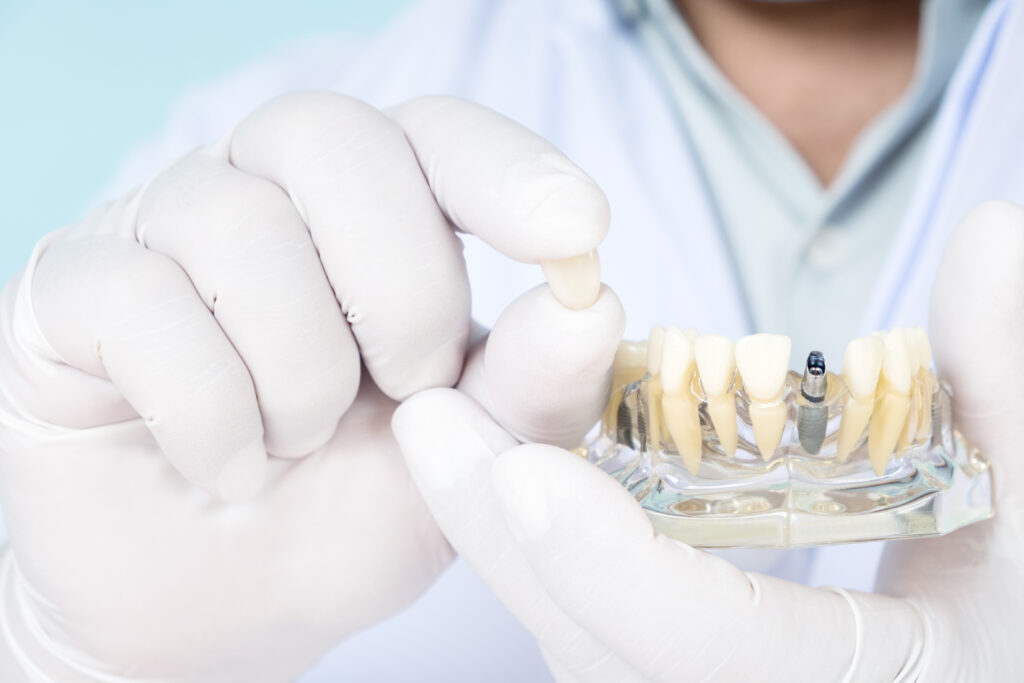 インプラントの歯の模型を持って、人工歯を前に出す男性医師
